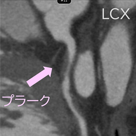 冠動脈CTA