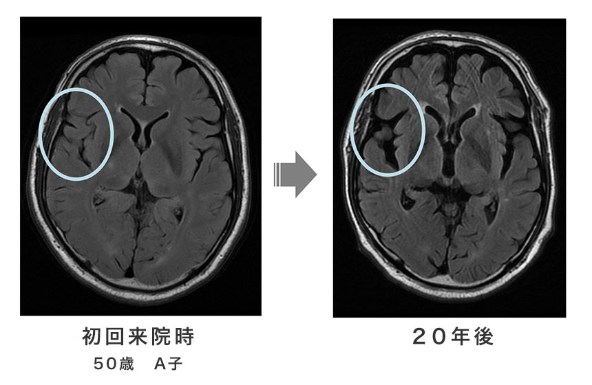 脳の萎縮　画像