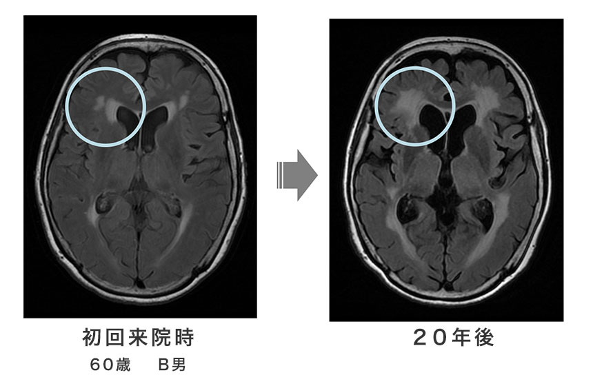 動脈硬化などによる脳の障害 画像