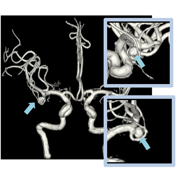 動脈瘤 画像