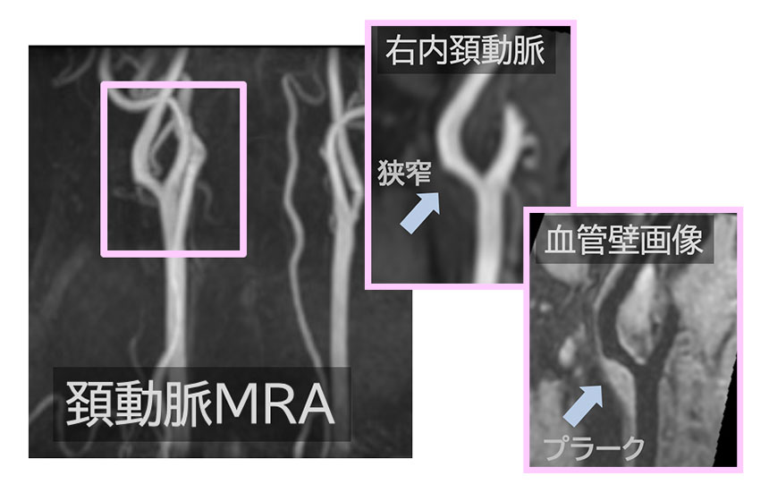 動脈硬化などによる脳の障害 画像