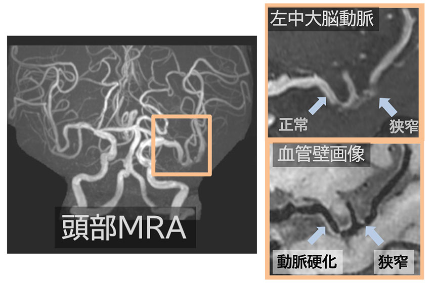 動脈硬化などによる脳の障害 画像